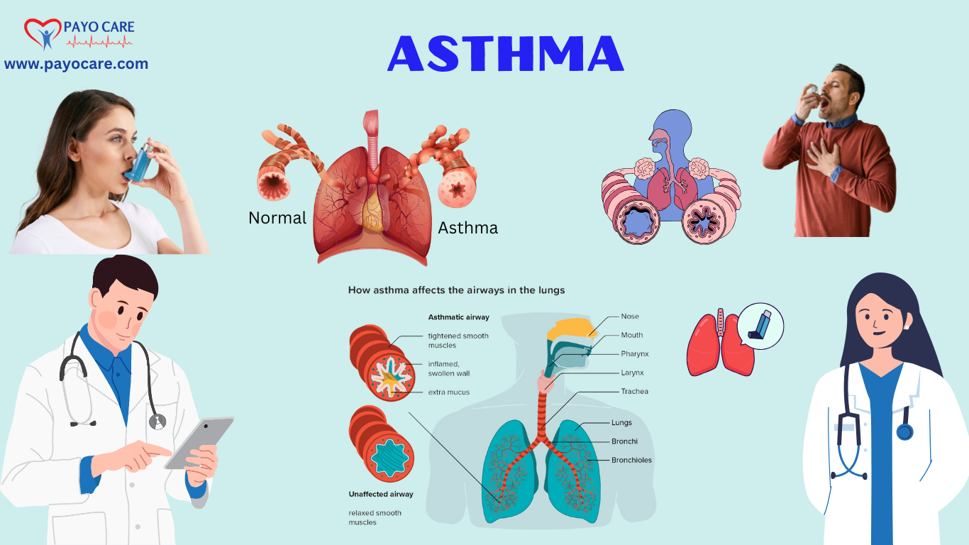 Asthma: Causes, Symptoms, Diagnosis & Treatments