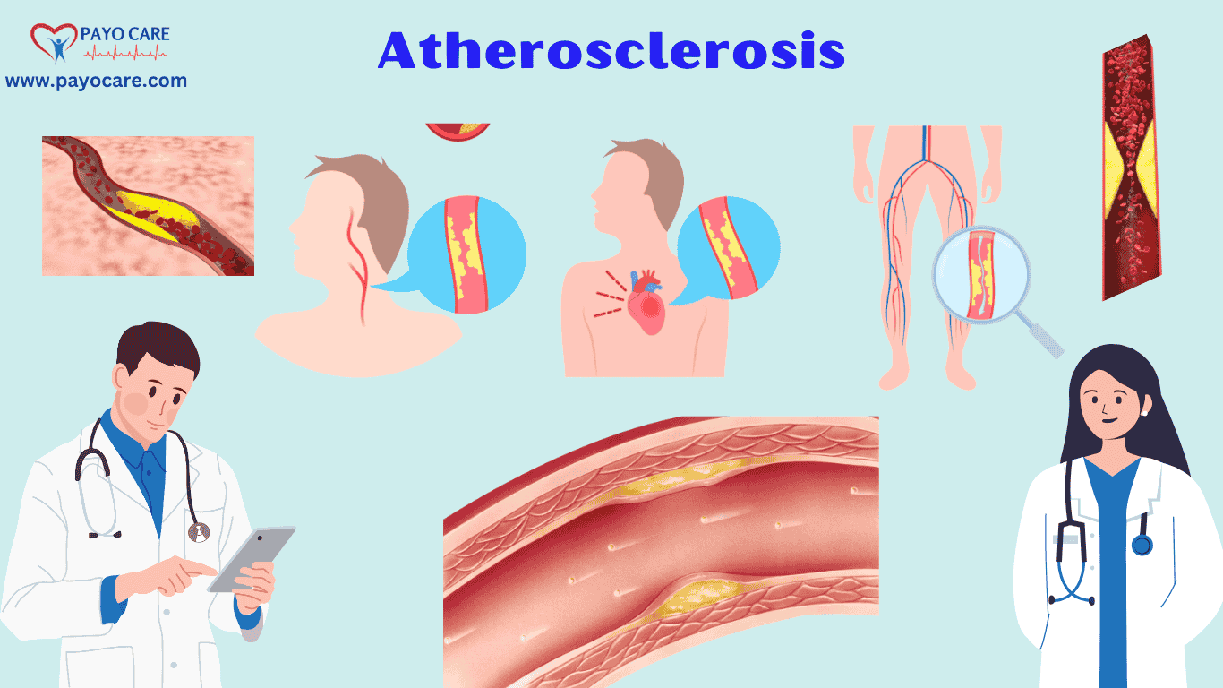 Atherosclerosis :Causes, Symptoms & Treatment