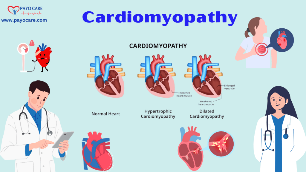 .Cardiomyopathy :Types, Causes, Symptoms, Prevention, Diagnosis & Treatment