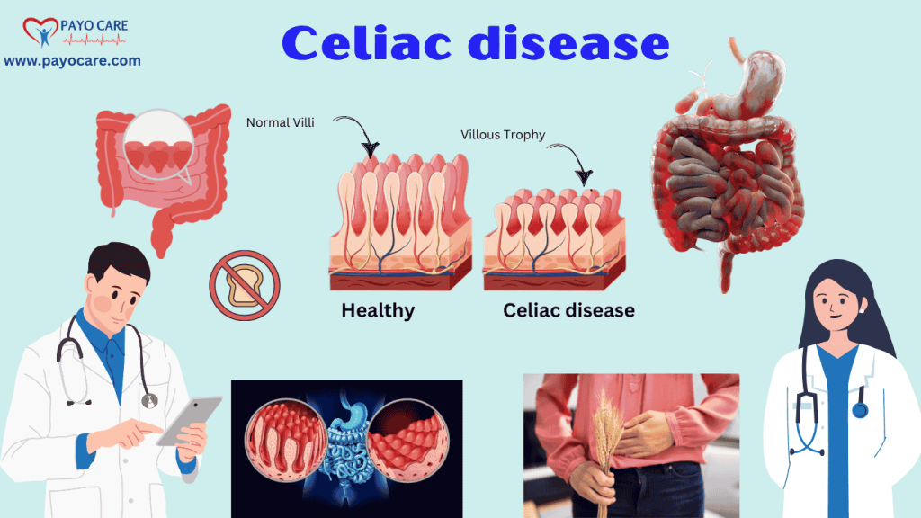 Celiac disease :Types, Causes, Symptoms, Prevention, Diagnosis & Treatment