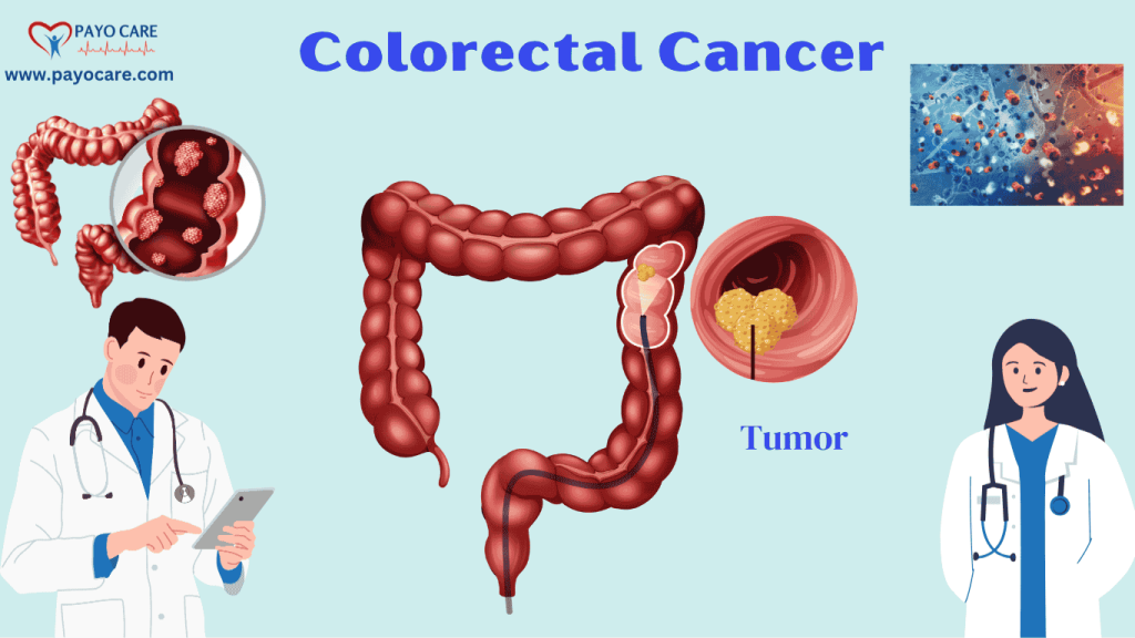 Colorectal Cancer: Causes, Symptoms & Treatments