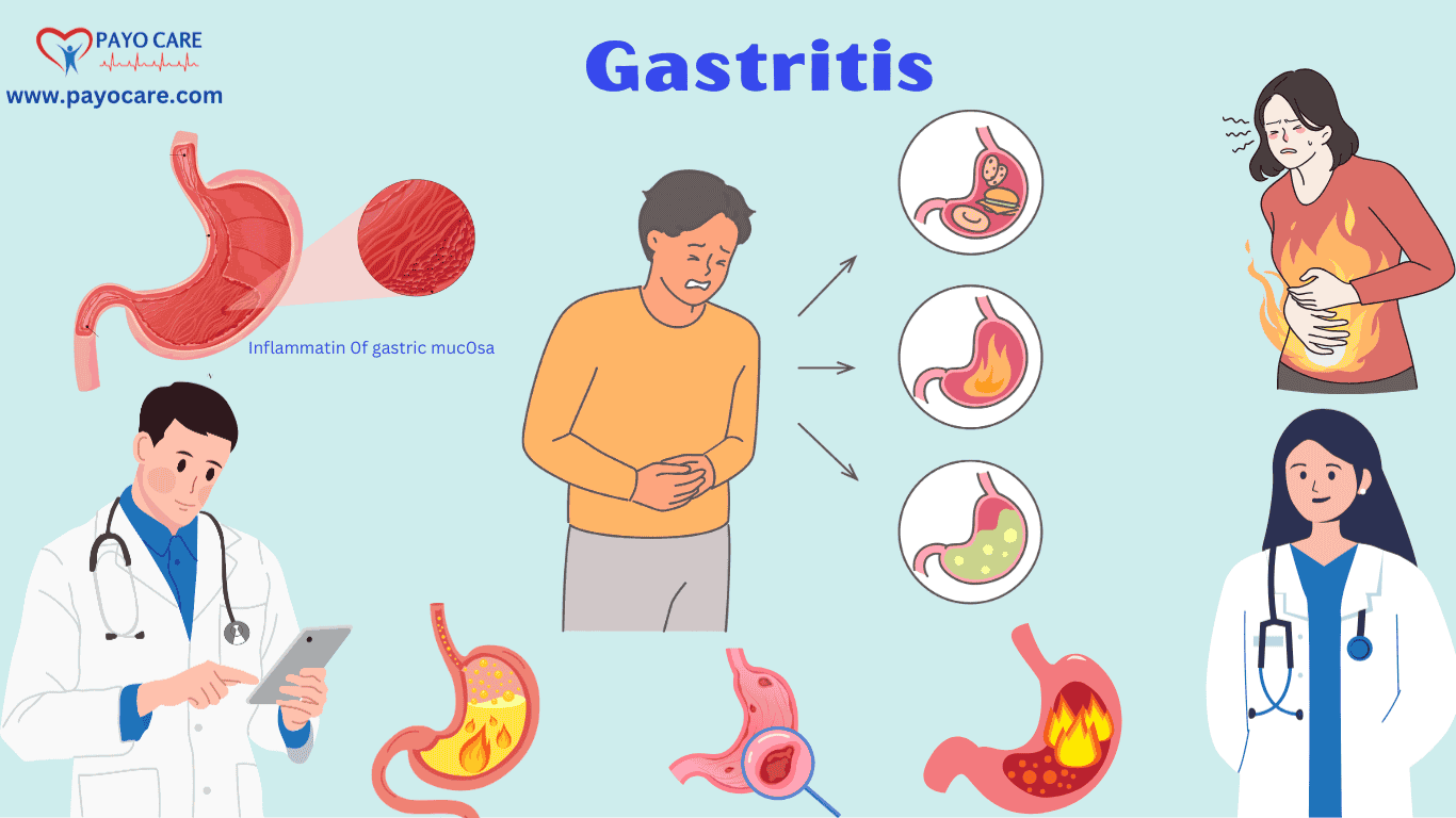 Gastritis: Causes, Symptoms, Prevention & Treatments