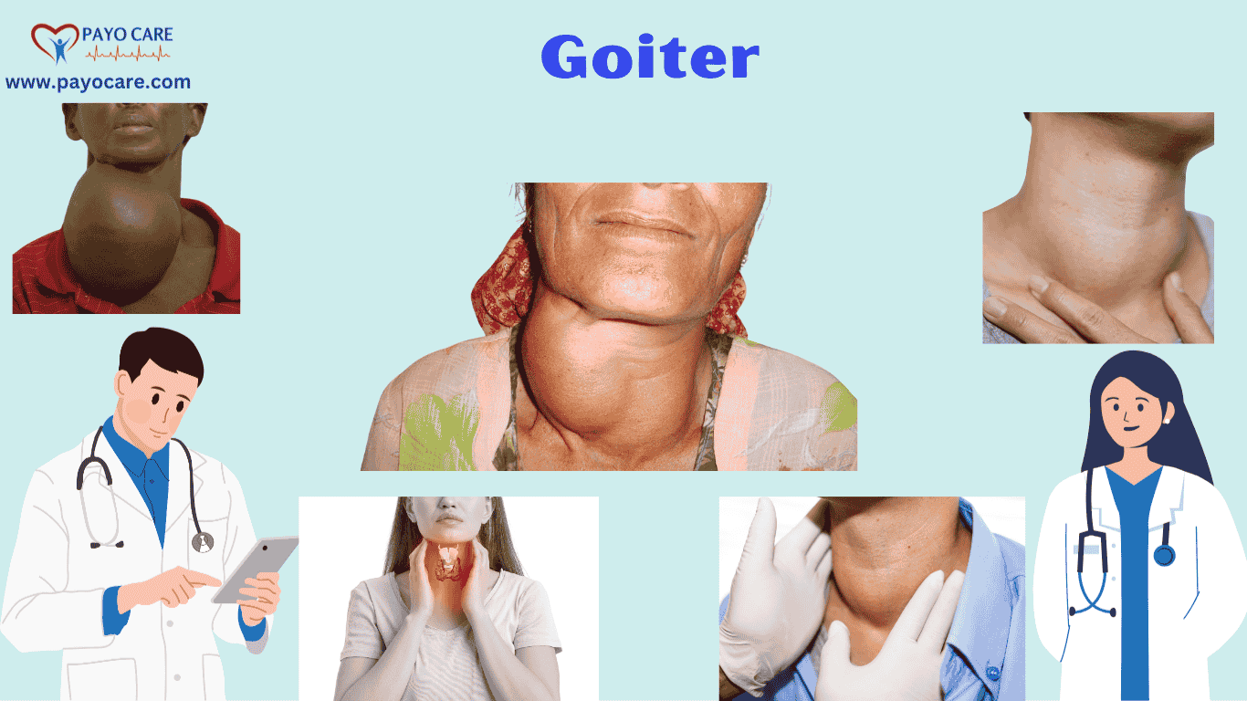 Goiter: Causes, Symptoms and Treatments