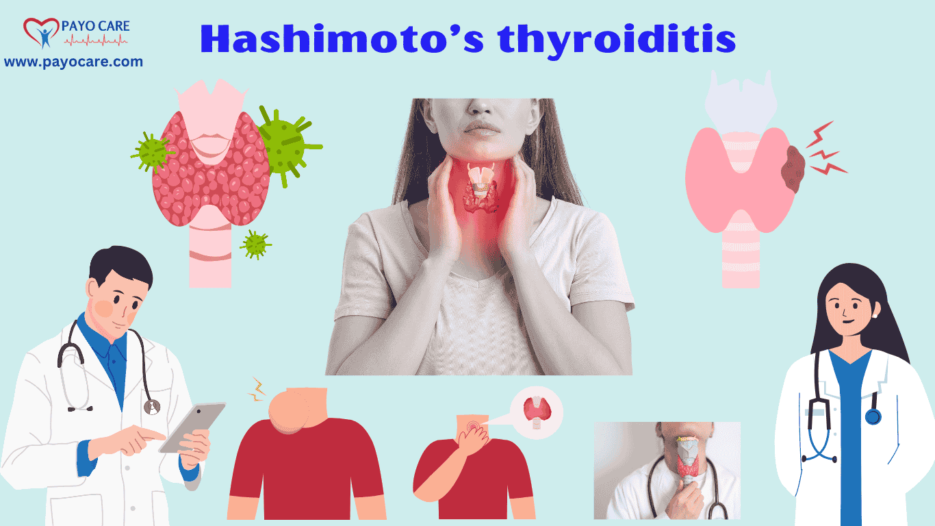 Hashimoto’s thyroiditis :Types, Causes, Symptoms, Prevention, Diagnosis & Treatment
