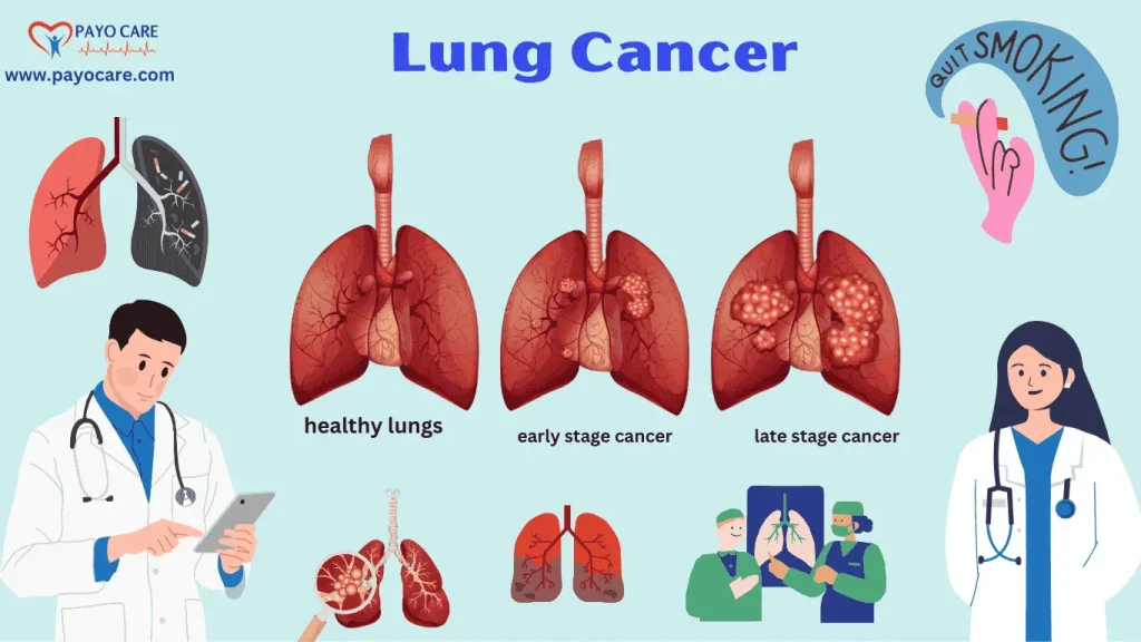 Lung Cancer:types,causes,symptoms,treatment,prevention and diagnosis 
