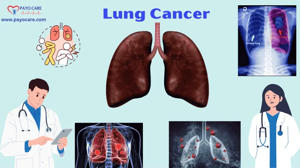 Lung Cancer
