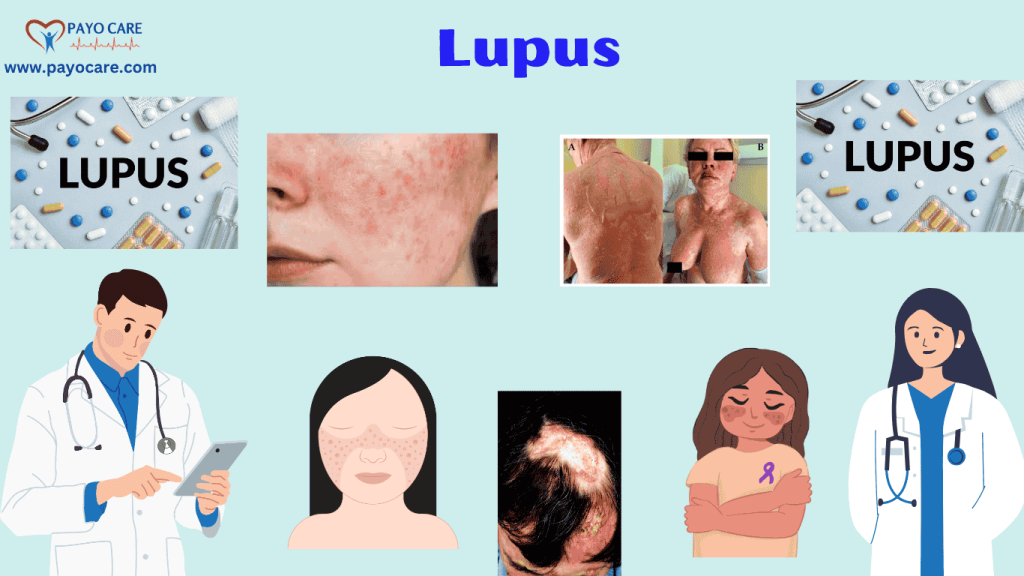 Lupus :Types, Causes, Symptoms, Prevention, Diagnosis & Treatment Lupus :Types, Causes, Symptoms, Prevention, Diagnosis & Treatment