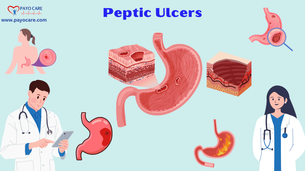 Peptic Ulcers: Types, Causes, Symptoms, Prevention, Diagnosis & Treatment