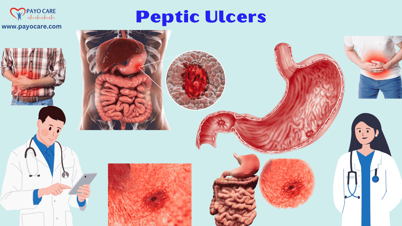 Peptic Ulcers :Causes, Symptoms & Treatment