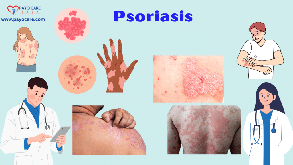 Psoriasis: Causes, Symptoms, Types, Prevention, and Treatment Psoriasis: Causes, Symptoms, Types, Prevention, and Treatment