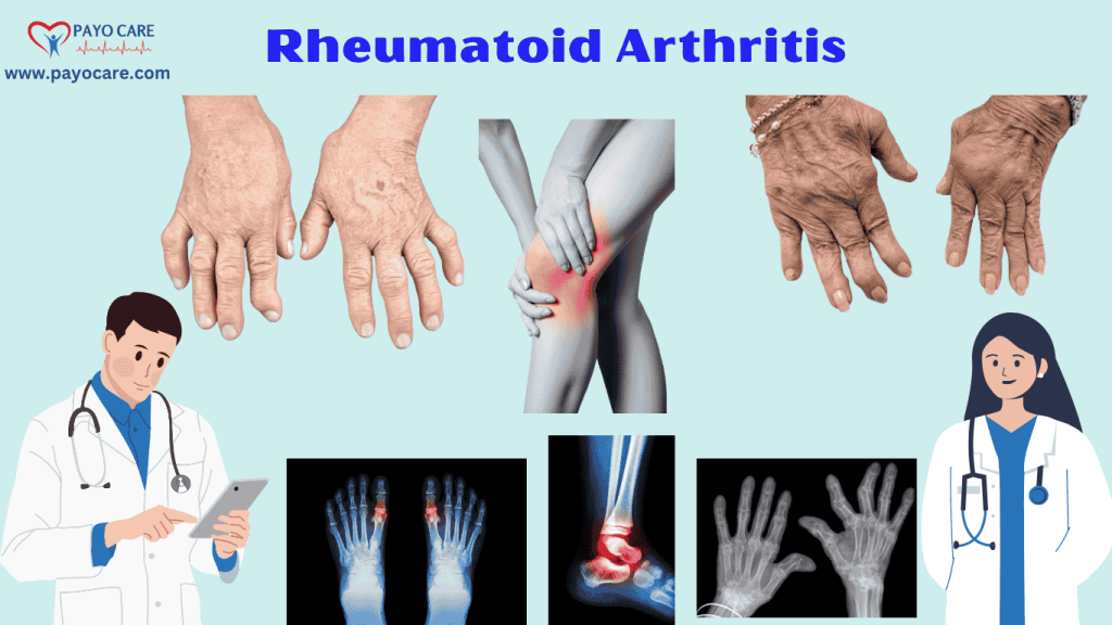 Rheumatoid Arthritis :Types, Causes, Symptoms, Prevention, Diagnosis & Treatment