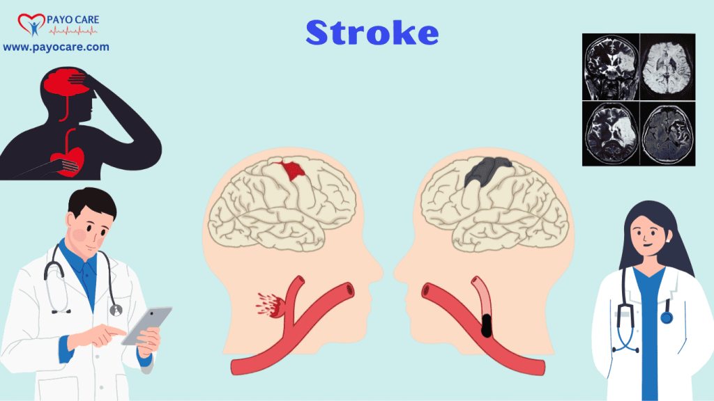 Stroke: Causes, Symptoms & Prevention