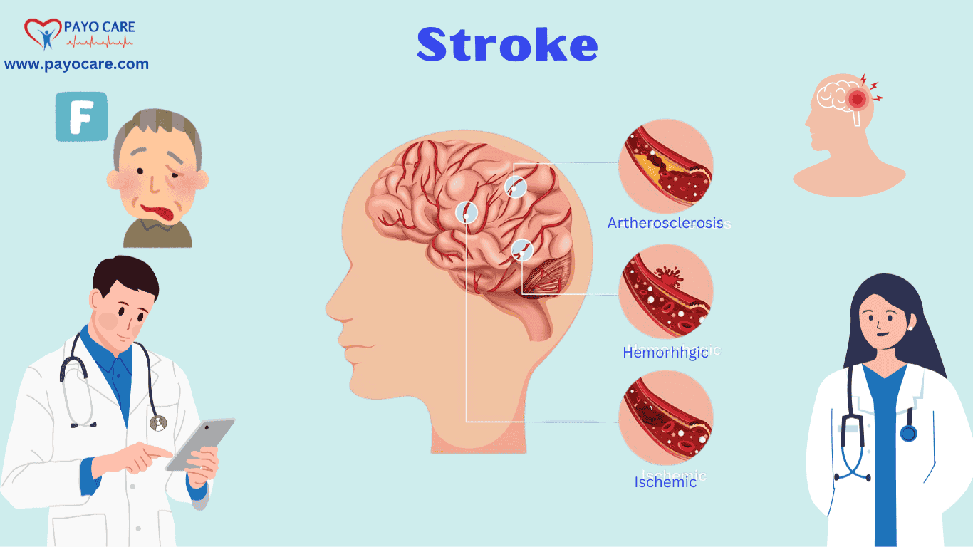 Stroke: Causes, Symptoms & Prevention