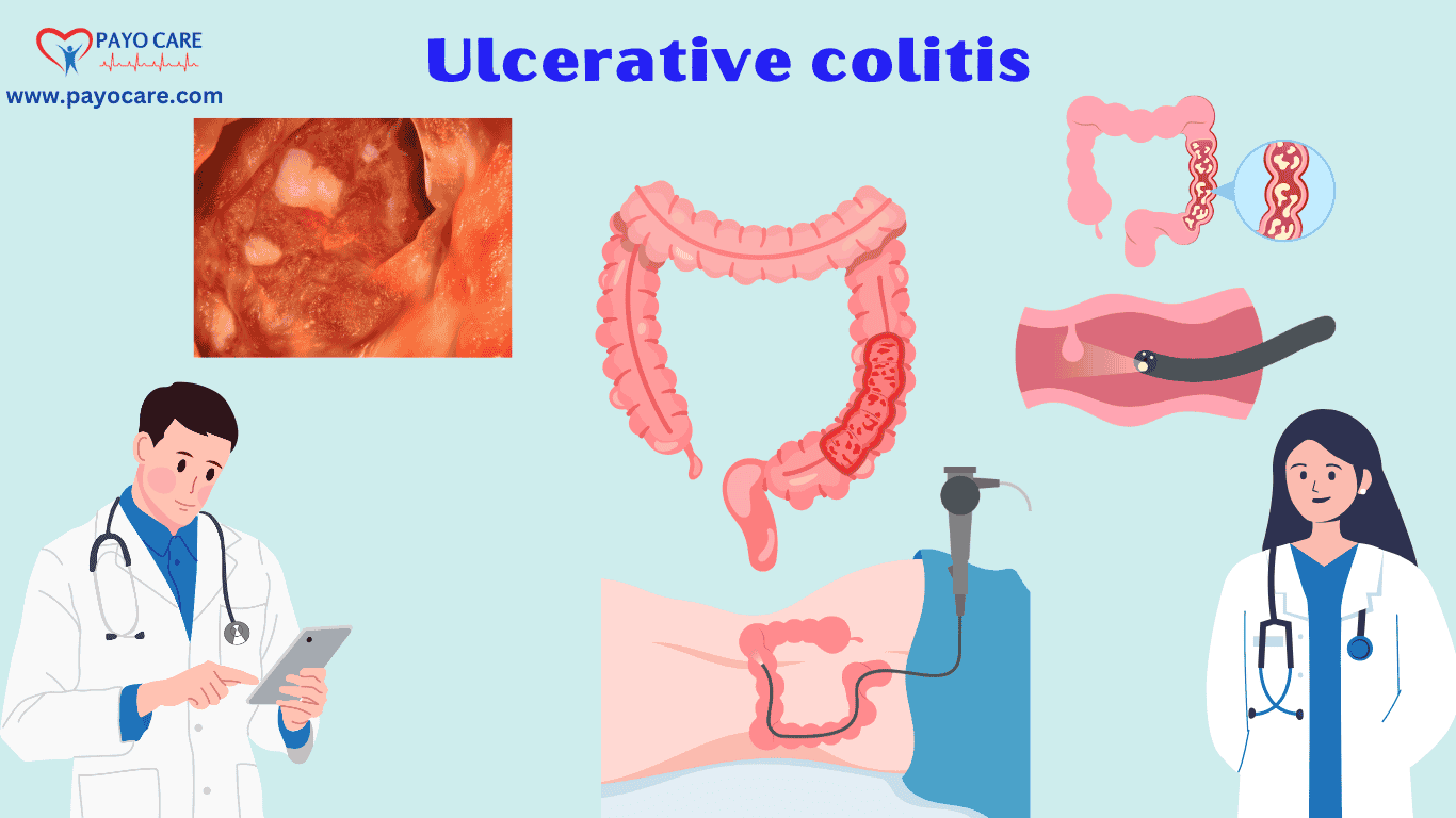 Ulcerative Colitis: Causes, Symptoms & Treatment