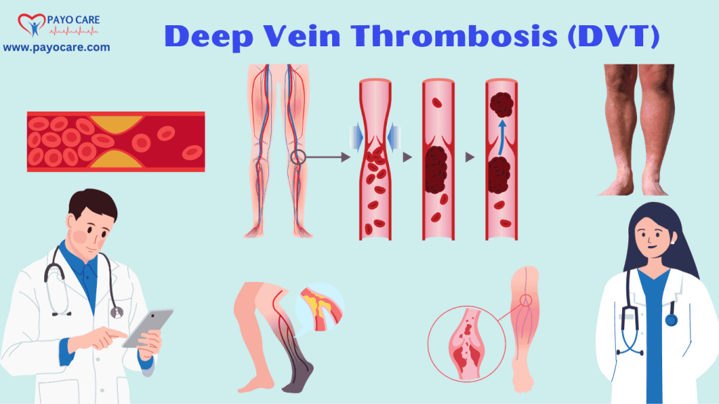 Deep Vein Thrombosis (DVT): Types, Causes, Symptoms, and Treatments