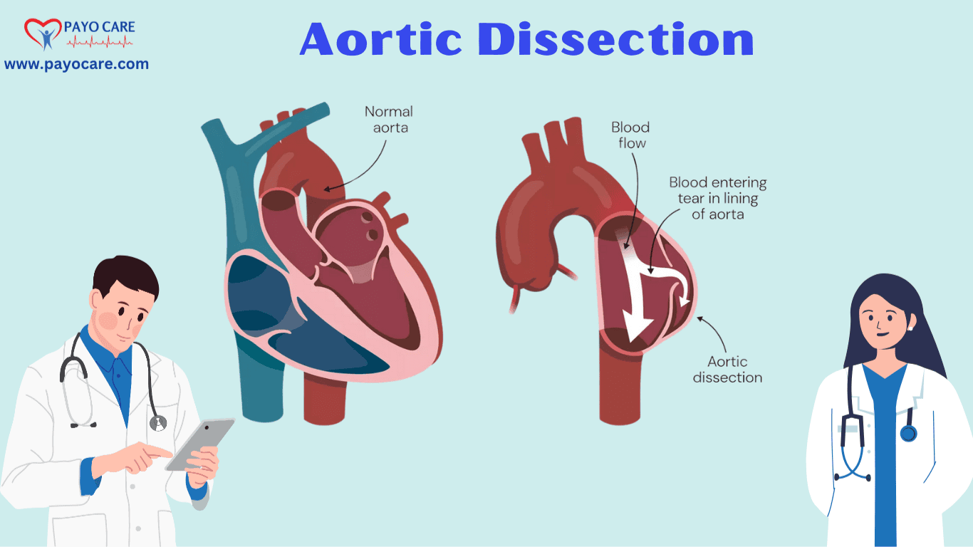 Aortic Dissection: Causes, Symptoms and Treatments