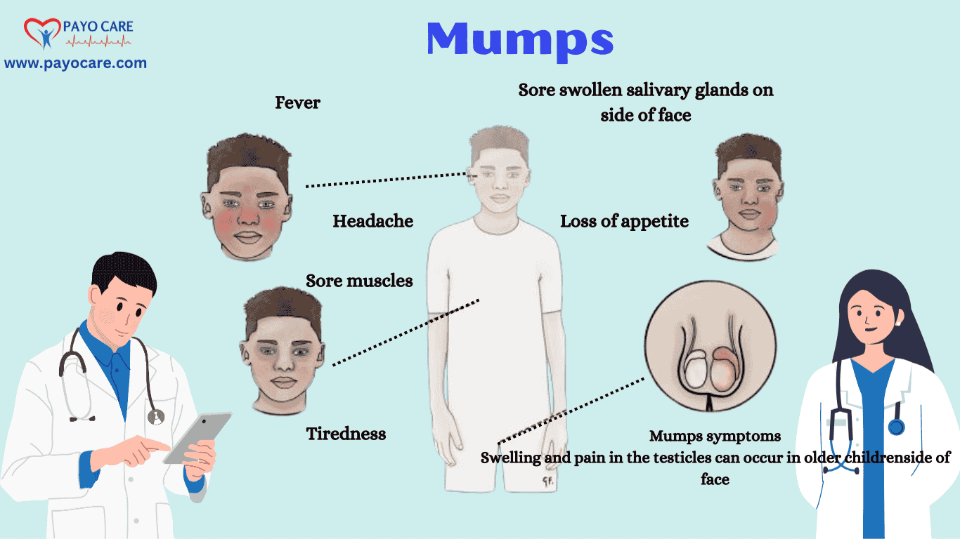 Mumps: Causes, Symptoms and Treatment