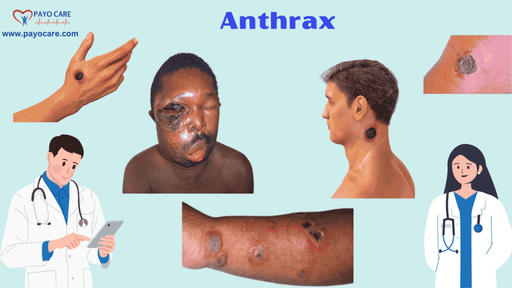 Anthrax: Types, Causes, Symptoms, Prevention, Diagnosis, and Treatment