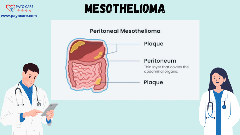 Mesothelioma :Types, Causes, Symptoms, Prevention, Diagnosis, and Treatment