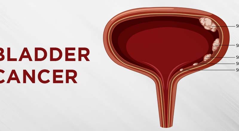 Bladder Cancer: Symptoms, Risk Factors, Diagnosis, Treatment, and Survival Rate